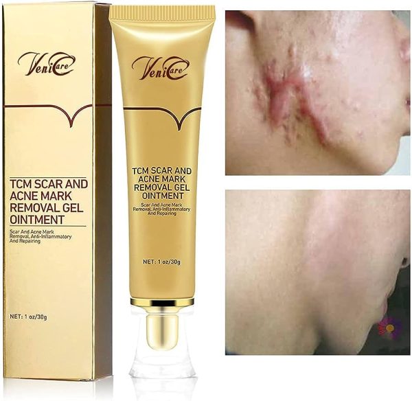 Acne Scars Gel Removal Cream