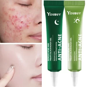 Acne Treatment Blackhead Removal Whitening