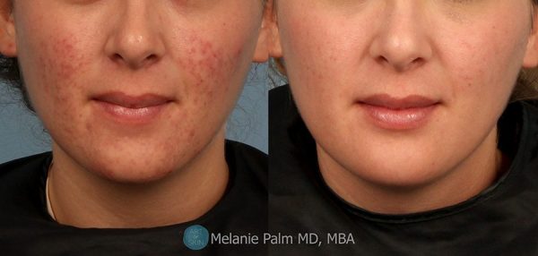 Cystic Acne Treatment and Acne Scar Remover - Effective Face & Body Severe Acne