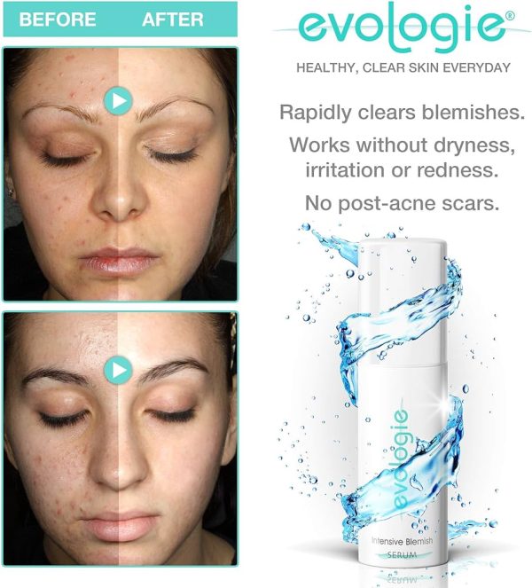 evologie Intensive Blemish Serum | Helps Clear Acne, Dark Spots &