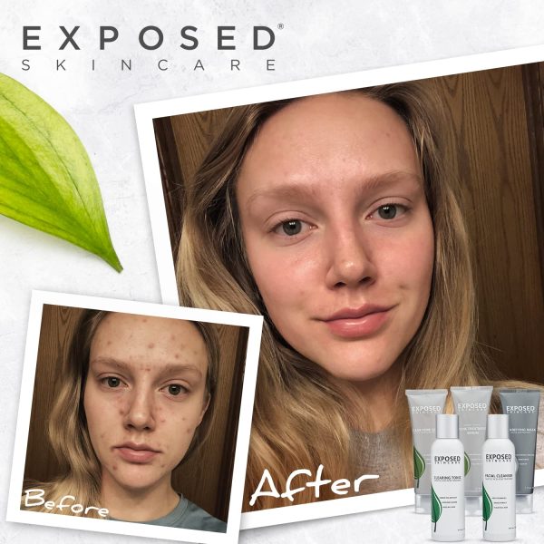 Exposed Skin Care Basic 5-Piece Teen and Adult Complete Acne Treatment System