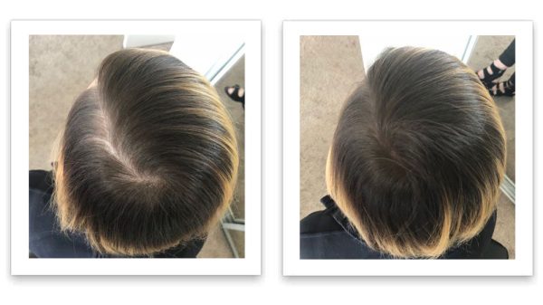 FEBRON Hair Building Fibers - Hair Loss Concealer For Thinning Hair