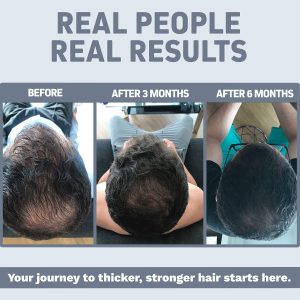 Foli-tonic DHT Blocker & Hair Loss Supplement