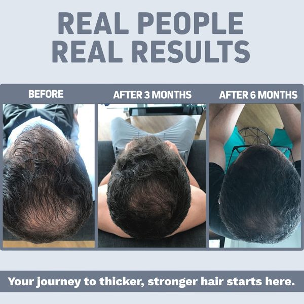 Foli-tonic DHT Blocker & Hair Loss Supplement