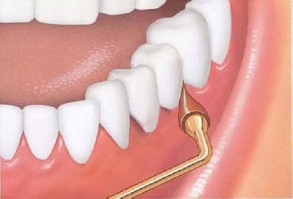 GUM Stimulator Permanent Handle with Rubber Tip