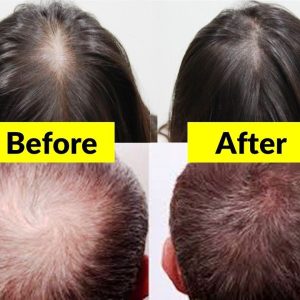 Hair Growth Oil MayBeau Upgrated Hair Growth Serum Hair Loss Treatment