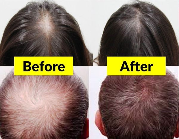 Hair Growth Oil MayBeau Upgrated Hair Growth Serum Hair Loss Treatment