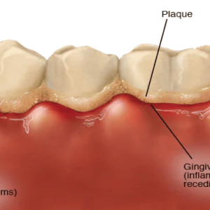 Helps Remove Recession, Plaque, Prevent Gingivitis