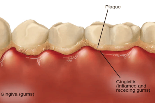 Helps Remove Recession, Plaque, Prevent Gingivitis