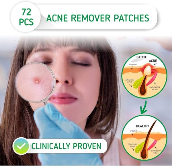 Levedi Acne Patch | Skin Care | Dark Spot Remover for Face | Acne Treatment