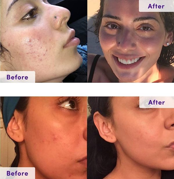 NxN Acne Treatment 4-Step Clear Skin System with Probiotics