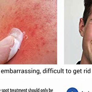 Puriderma Acne Spot Treatment for Acne Prone Skin, Mild, Moderate, Severe