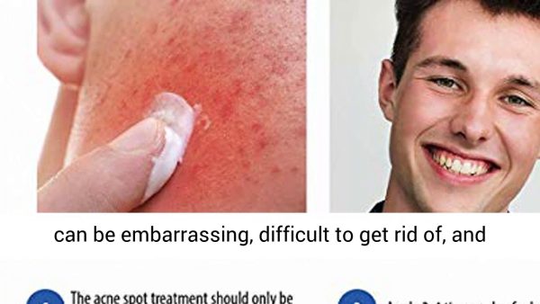 Puriderma Acne Spot Treatment for Acne Prone Skin, Mild, Moderate, Severe