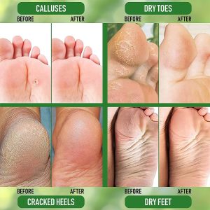 PurSources Urea 40% Foot Cream 4 oz - Best Callus Remover