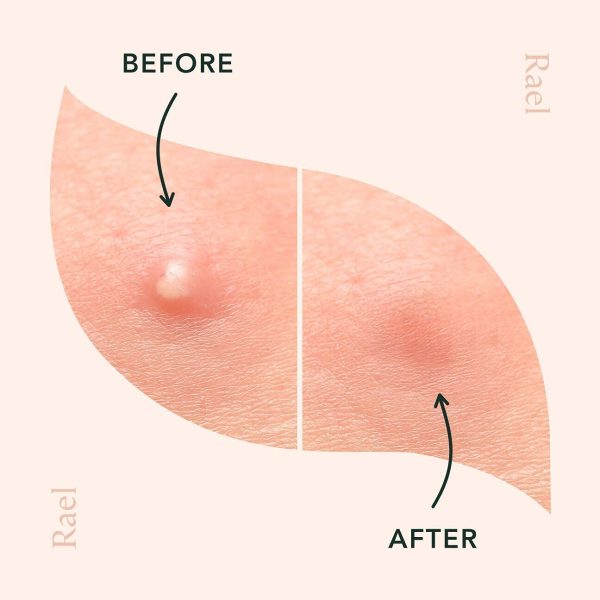 Rael Acne Pimple Healing Patch - Absorbing Cover, Invisible, Blemish Spot