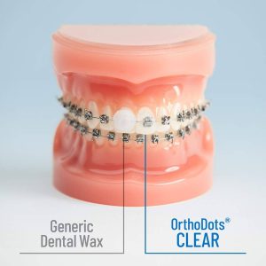 Silicone Dental Wax Alternative for Pain Caused by Braces.