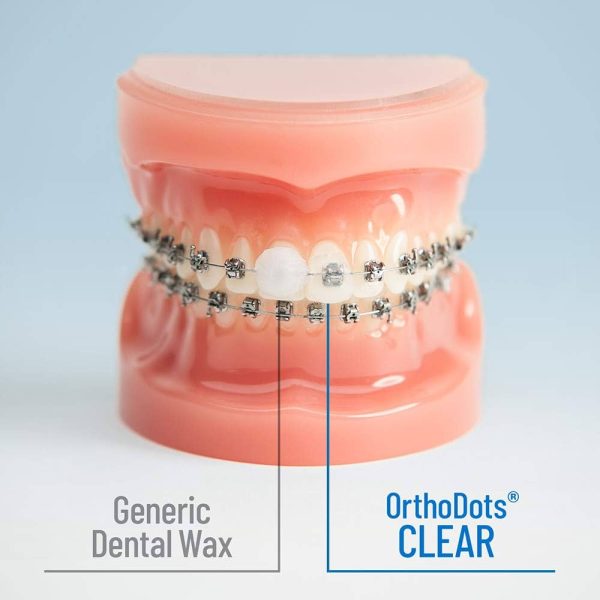 Silicone Dental Wax Alternative for Pain Caused by Braces.