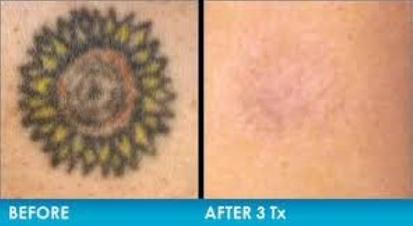 Tattoo Removal Cream 3 Step Action: The Daily Use of Profade Helps