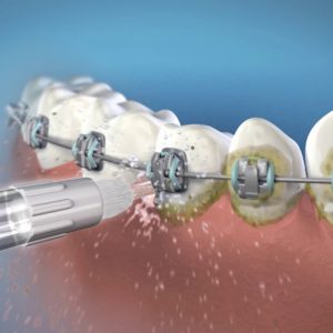 Waterpik Flosser for Teeth, Gums, Braces
